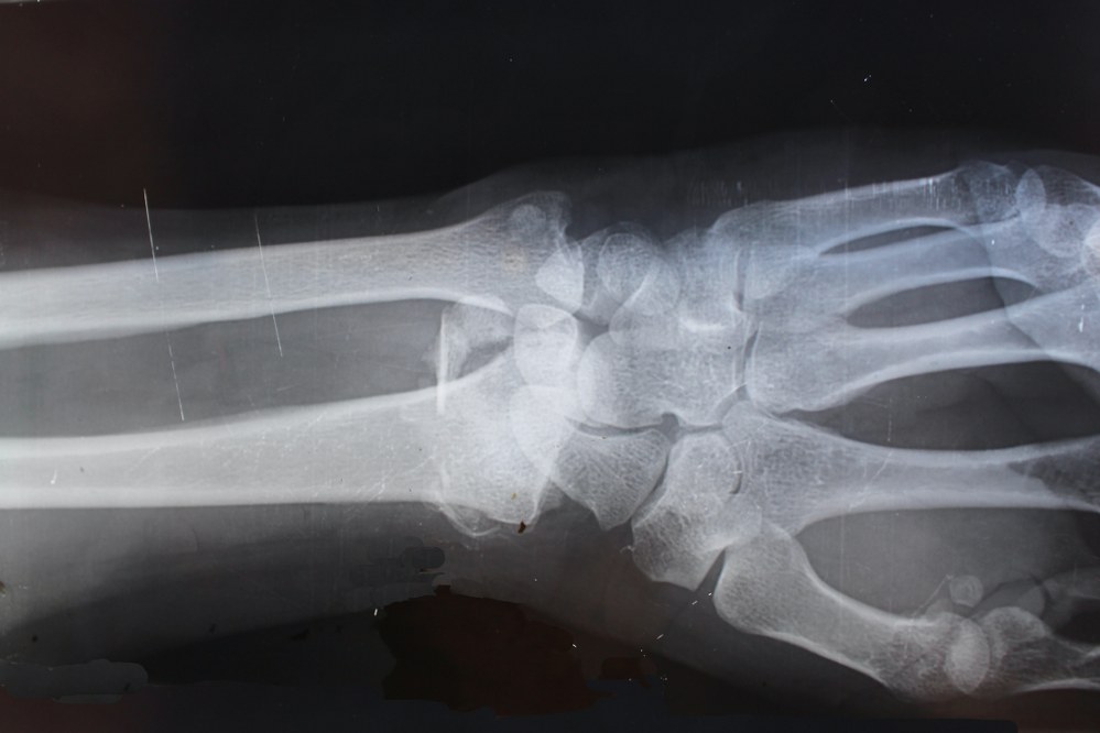 X-ray of wrist - take your medical records when booking a medical tourism trip